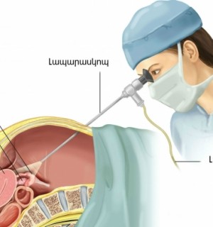 Լապարասկոպիա