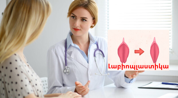 Սեռական շուրթերի ասիմետրիա:Լաբիոպլաստիկա: